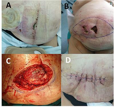 Extensive Abdominal Skin Necrosis Following Anterior Component Separation for a Large Ventral Hernia: A Case Report